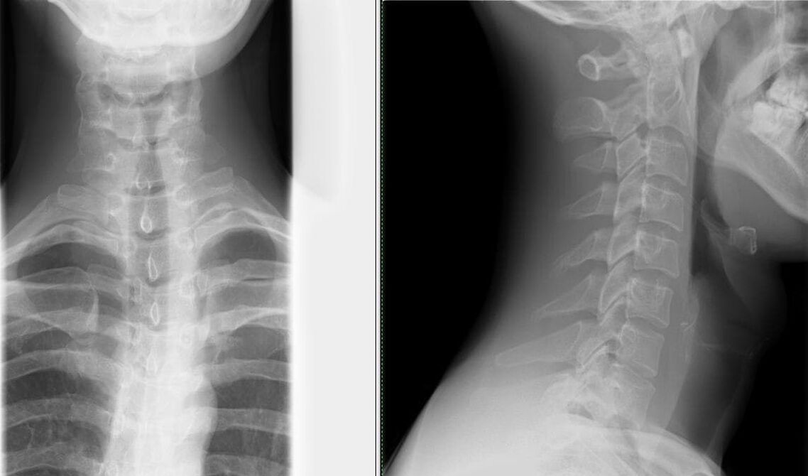 Orqa miya rentgenogrammasi osteoxondrozni tashxislashning oddiy va samarali usuli hisoblanadi