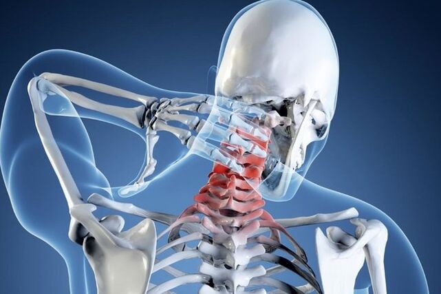 servikal o'murtqa osteoxondroz